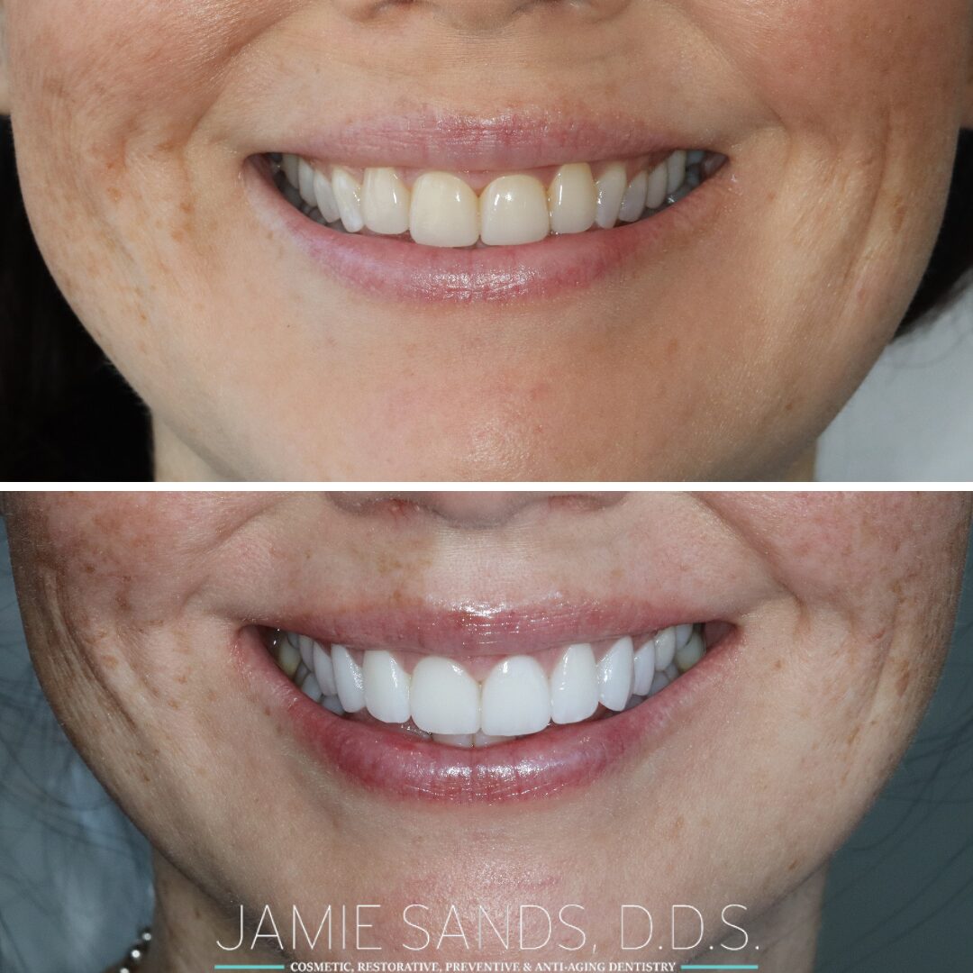 before-after-14