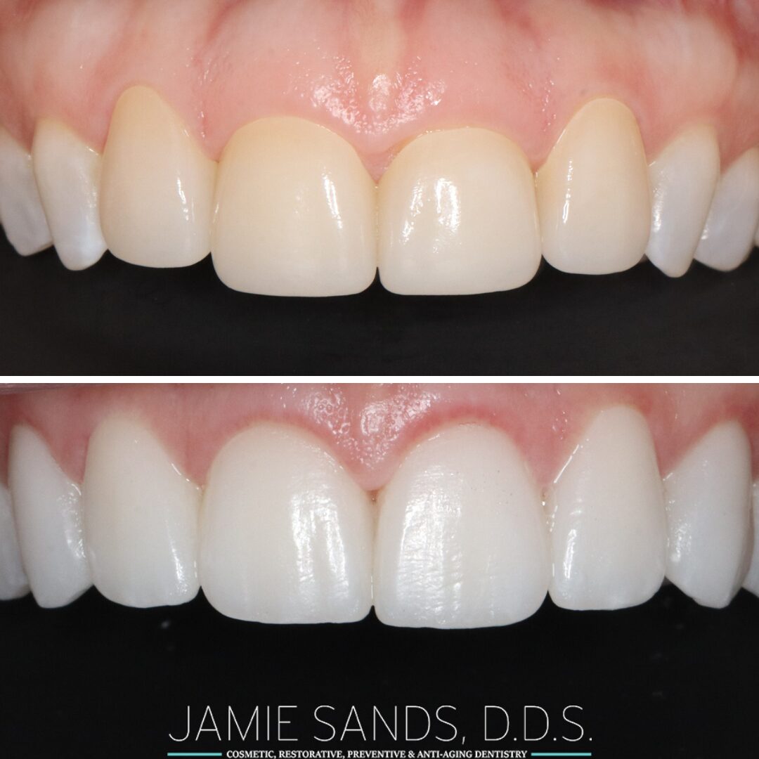 before-after-15